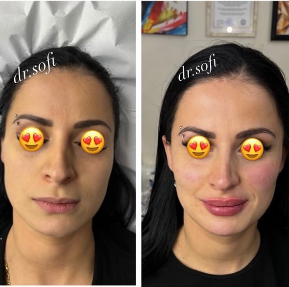 ბოტოქსის ინექციები